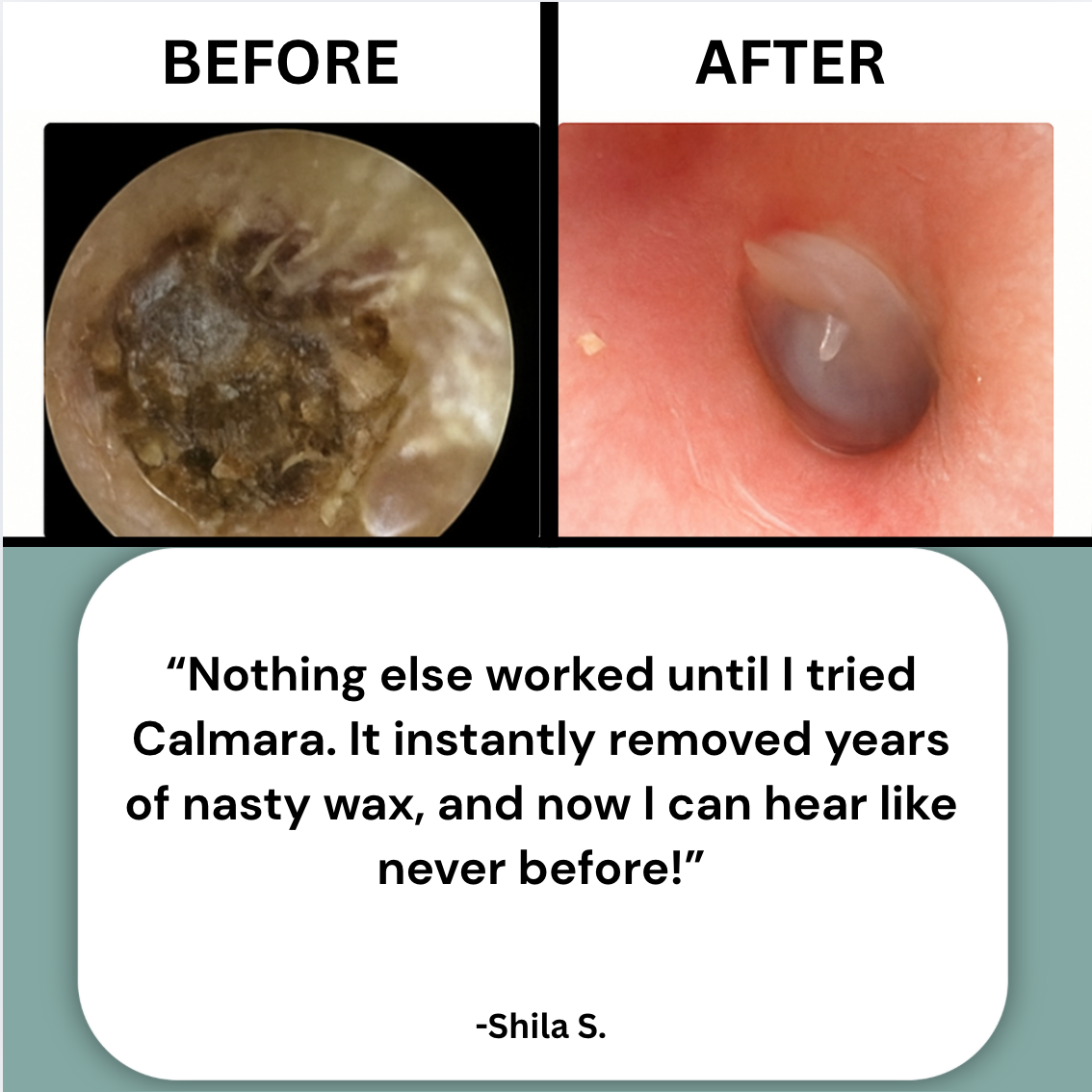 Ear Wax Remover